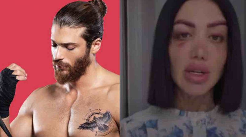 L'estetista di Can Yaman massacrata di botte il motivo dell'aggressione e come sta
